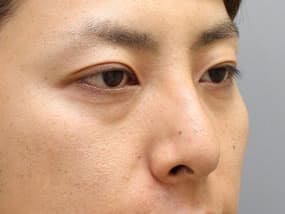 手術前（斜め）