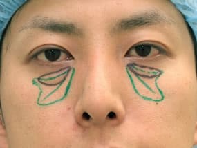 手術デザイン（正面）