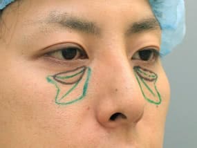 手術デザイン（斜め）