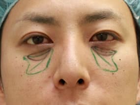 経結膜脱脂直後（正面）
