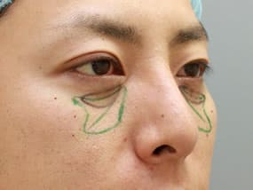 経結膜脱脂直後（斜め）