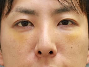 手術3日後（正面）