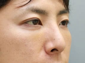 手術1週間後（斜め）