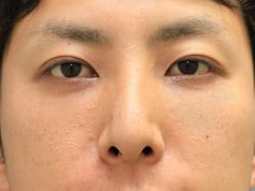 手術2週間後（正面）