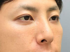 手術2週間後（斜め）