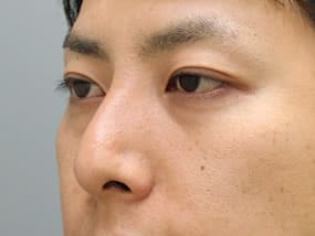 右斜め　手術前