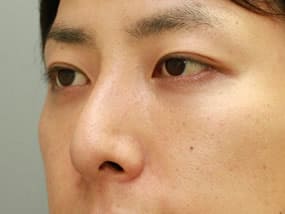 右斜め　手術1ヶ月後