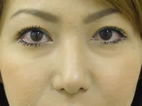 経結膜脱脂の手術前（正面）
