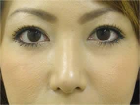 経結膜脱脂の手術前（正面）