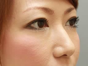 手術1週間後（斜め）
