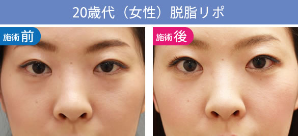 目の下のくま・たるみ治療（クマ取り）【大阪】脱脂リポの20歳の症例
