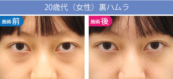 目の下のくま・たるみ治療（クマ取り）【大阪】裏ハムラの20歳代の症例