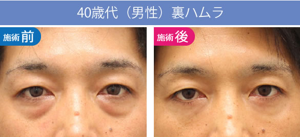 目の下のくま・たるみ治療（クマ取り）【大阪】裏ハムラの40歳代の男性症例