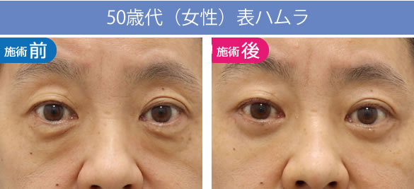 目の下のくま・たるみ治療（クマ取り）【大阪】表ハムラの50歳代の症例