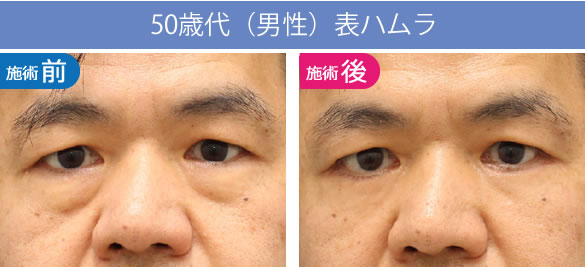 目の下のくま・たるみ治療（クマ取り）【大阪】表ハムラの50歳代の男性症例