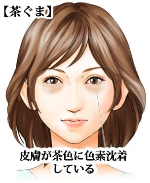 目の下のくま・たるみ「茶ぐま」