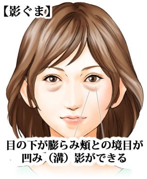 目の下のくま・たるみ「影ぐま」