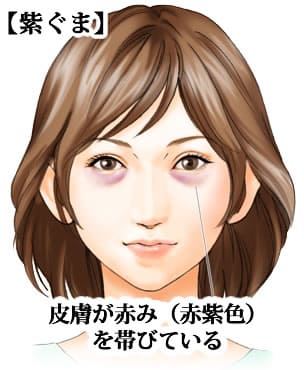 目の下のくま・たるみ「紫ぐま」