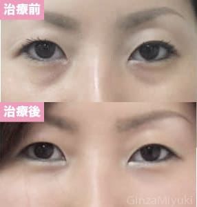 モニター症例№11（33歳 女性）脱脂ダブルリポ