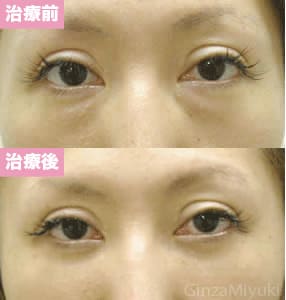 モニター症例№17（29歳 女性）脱脂ダブルリポ