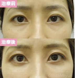 モニター症例№30（38歳 女性）脱脂ダブルリポ