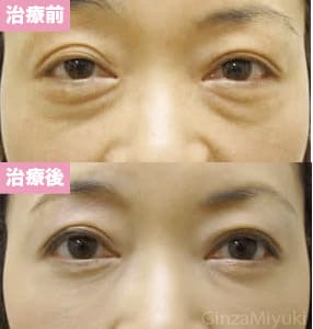 モニター症例№31（50歳 女性）脱脂ダブルリポ