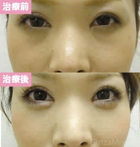 モニター症例№32（28歳 女性）脱脂ダブルリポ