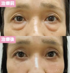 モニター症例№37（53歳 女性）脱脂ダブルリポ