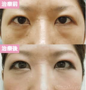モニター症例№39（29歳 女性）脱脂ダブルリポ
