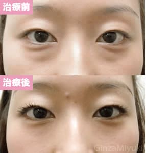 モニター症例№49（27歳 女性）脱脂ダブルリポ