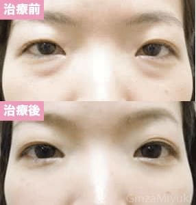 モニター症例№50（30歳 女性）脱脂ダブルリポ