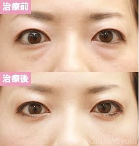 モニター症例№62（28歳 女性）脱脂コンデンスリポ