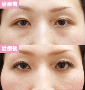 モニター症例№64（33歳 女性）脱脂コンデンスリポ