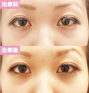 モニター症例№82（22歳 女性）脱脂ダブルリポ