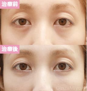 モニター症例№84（26歳 女性）脱脂コンデンスリポ