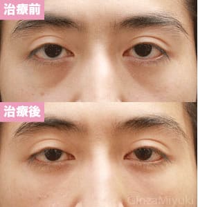 モニター症例№85（31歳 男性）脱脂コンデンスリポ