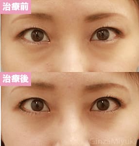 モニター症例№87（25歳 女性）脱脂ダブルリポ