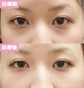 モニター症例№89（25歳 女性）脱脂コンデンスリポ