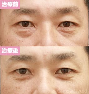 モニター症例№91（46歳 男性）脱脂コンデンスリポ
