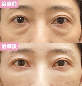 モニター症例№101（46歳 女性）脱脂コンデンスリポ