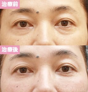 モニター症例№105（52歳 女性）脱脂コンデンスリポ