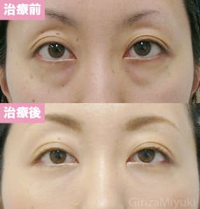モニター症例№110（31歳 女性）脱脂ダブルリポ