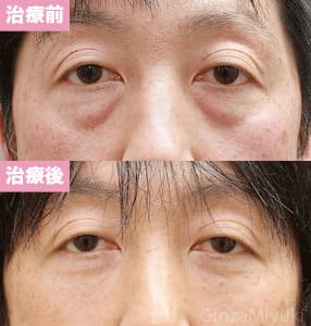 モニター症例№123（44歳 男性）脱脂コンデンスリポ