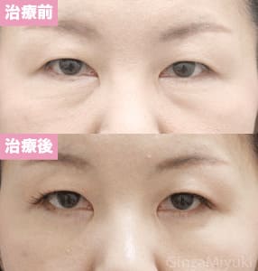 モニター症例№147（46歳 女性）脱脂コンデンスリポ
