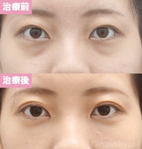 モニター症例№149（22歳 女性）脱脂コンデンスリポ