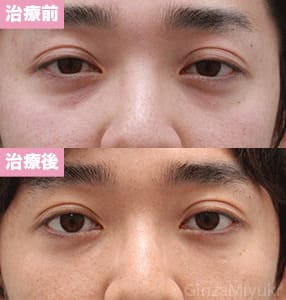 モニター症例№167（27歳 男性）脱脂コンデンスリポ