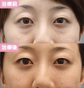 モニター症例№171（33歳 女性）脱脂ダブルリポ