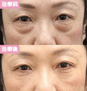 モニター症例№180（56歳 女性）脱脂コンデンスリポ