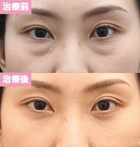 モニター症例№190（35歳 女性）脱脂コンデンスリポ