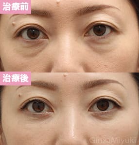 モニター症例№192（40歳 女性）脱脂コンデンスリポ